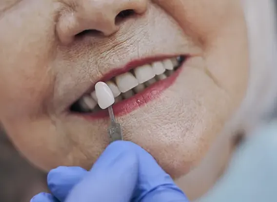 facetas de porcelana